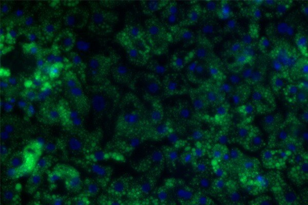 Image of MASLD cells treated with free fatty acids