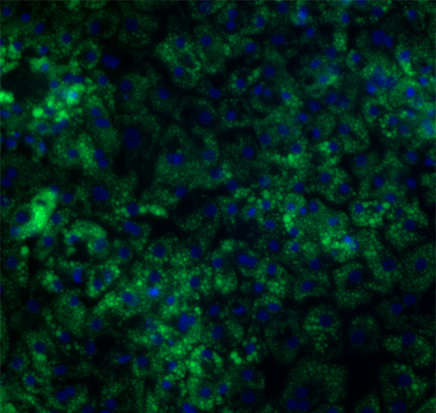 MASLD model treated with free fatty acids