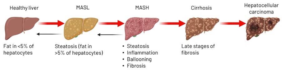 Progression of MASLD from fatty liver to Hepatocellular carcinoma